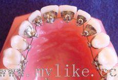 成人隐形矫正牙齿视频,视频解析与效果展示