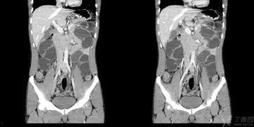成人肛门排气正常吗视频,正常现象还是健康警示？