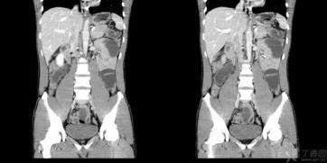 成人肛门排气正常吗视频,正常现象还是健康警示？