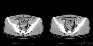 成人肛门排气正常吗视频,正常现象还是健康警示？