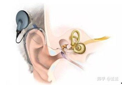 成人耳蜗导线使用视频,视频解析与操作指南