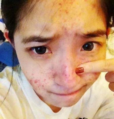 成人痘痘治疗对比视频