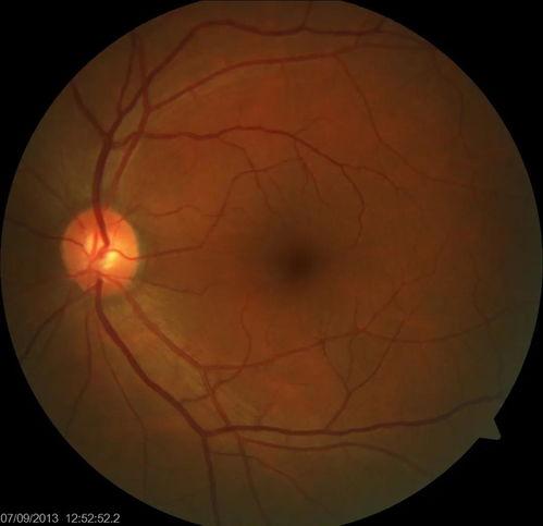 成人眼底检查视频教程,全面解析眼底检查技巧与要点