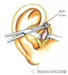 成人耳朵弯曲手术视频