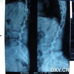 脊椎弯曲视频成人,从视频到现实的人生蜕变之旅