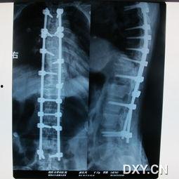 脊椎弯曲视频成人,从视频到现实的人生蜕变之旅